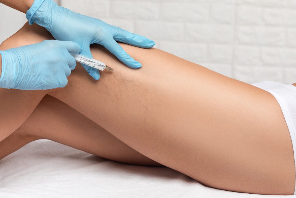 Vanishing Veins: Expert Removal Treatments at Skinox Aesthetics